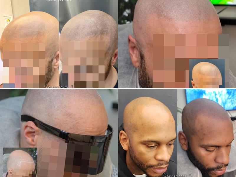 Elegant Scalp Micropigmentation