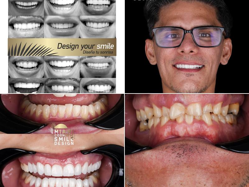 Miami Cosmetic Smile Design