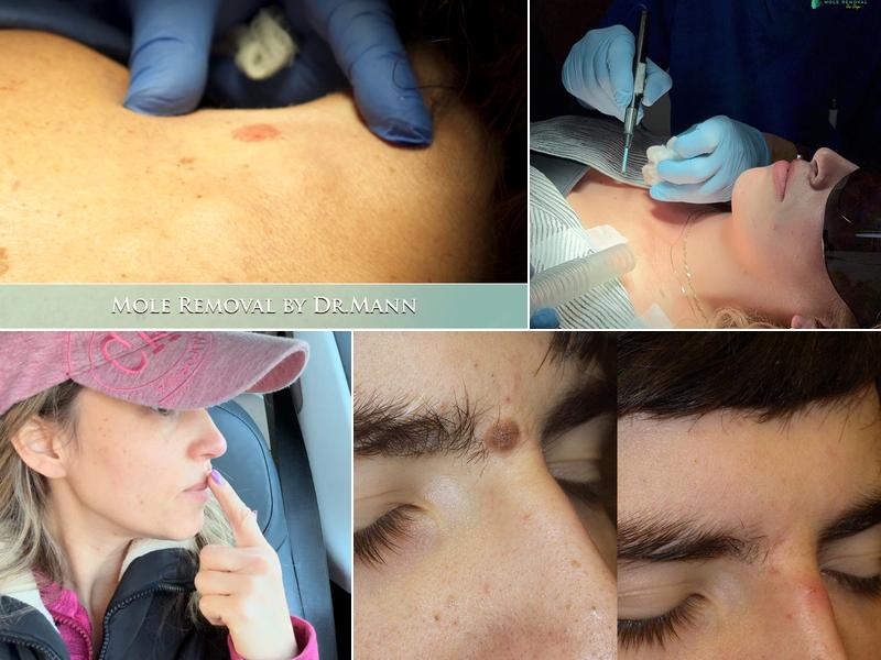 Mole Removal San Diego