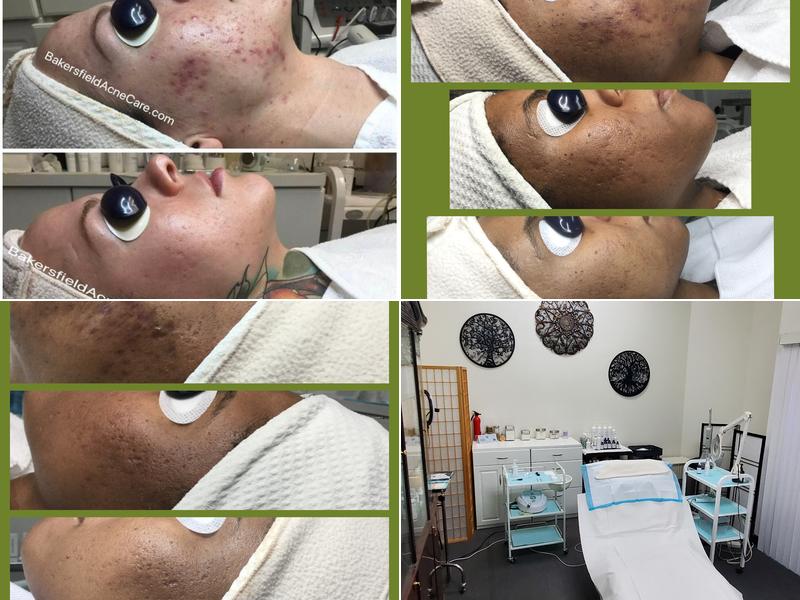 Bakersfield Acne Care (by appointment only)
