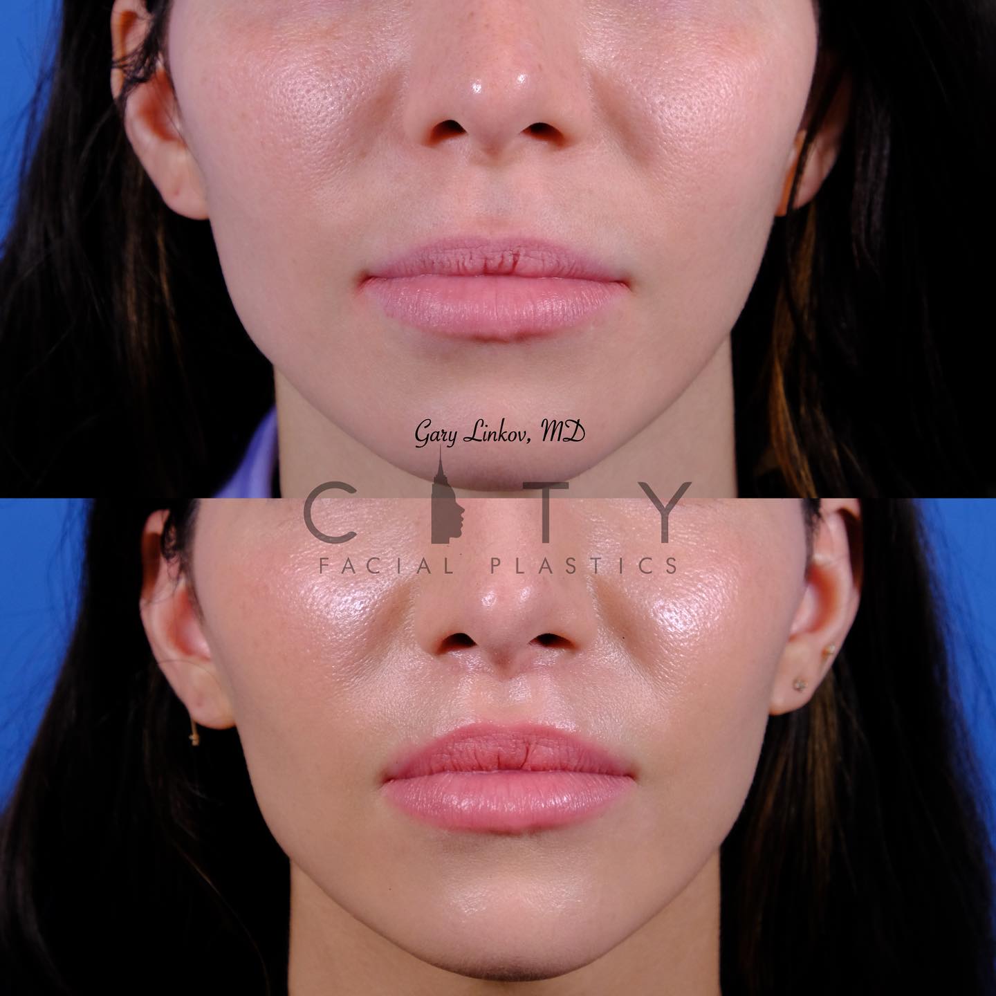 City Facial Plastics: Dr. Gary Linkov 150 East 56th StSuite 1AB, New York