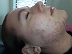 Skintherapy Skincare & Acne Clinic